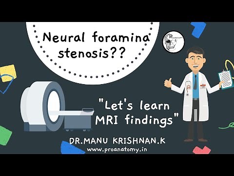 What is "Neural Foramina Stenosis(Neural foramina narrowing)"???- & spinal nerve root compression