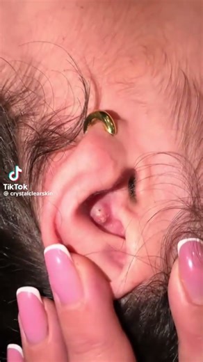 Juicy Ear Pop