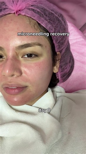Microneedling Recovery Journey: Days 0 to 3