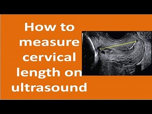 How to Measure Cervical Length by Ultrasound