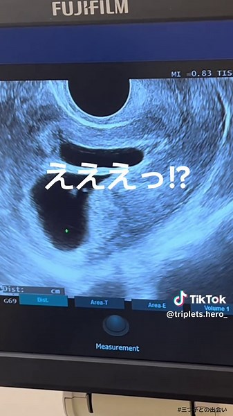 多胎妊娠のリアルをお届けします！三つ子の奇跡体験