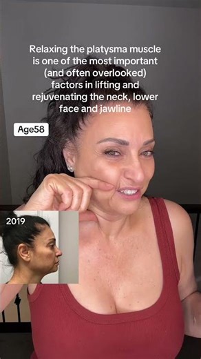 The platysma is a thin, sheet-like muscle that runs from the upper chest and collarbone up to the