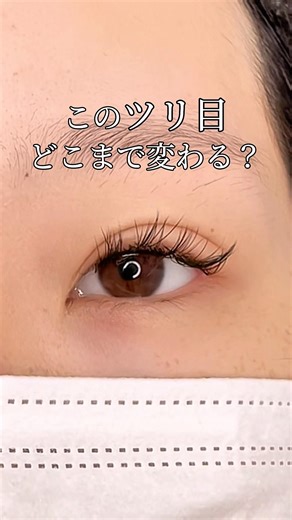 つり目→タレ目へ#二重整形 #眼瞼下垂 #shorts