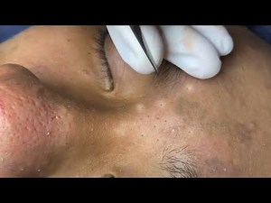 Blackheads on Forehead ! Relax Acne Treatment Every Day