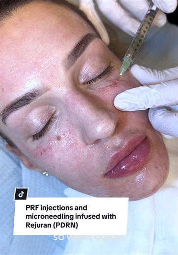 Today with PA Steve, he combined two powerhouse treatments: PRF injections and microneedling infused with Rejuran (PDRN) — a perfect pairing for patients looking to boost collagen, improve texture, and rejuvenate the skin from the inside out. PRF injections use your body’s own growth factors to stimulate deep collagen production, enhance healing, and improve tone and elasticity. Microneedling with Rejuran (PDRN) delivers salmon-derived polynucleotides directly into the skin, helping repair cellu