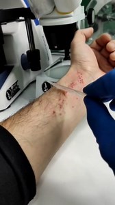 HYPOCUTANEOUS MITE, SCABIES UNDER A MICROSCOPE #science | Mir Glazami Microscopa