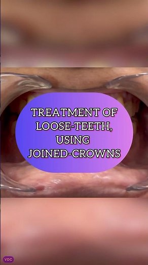 Treating Loose Teeth With Joined-Crowns(Caps)