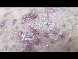 Relax Every Day With Wellness Spa #131 Acne Treatment | Best Sac Dep Spa | Blackheads | Sac Dep Spa