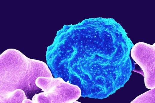 La Jolla Labs Roll Out Triple-Strike Attack On Stubborn Ovarian Cancer