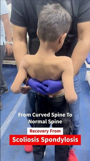 Scoliosis & Spondylitis Recovery Without Surgery? 😱 | Chiropractic Miracle by Dr. Rajneesh Kant