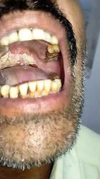Oral Thrush After Steroid Ointment Used For Oral Ulcers