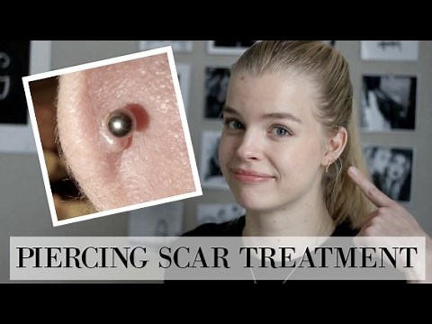 How to treat Hypertrophic Scars/Piercing Bumps!
