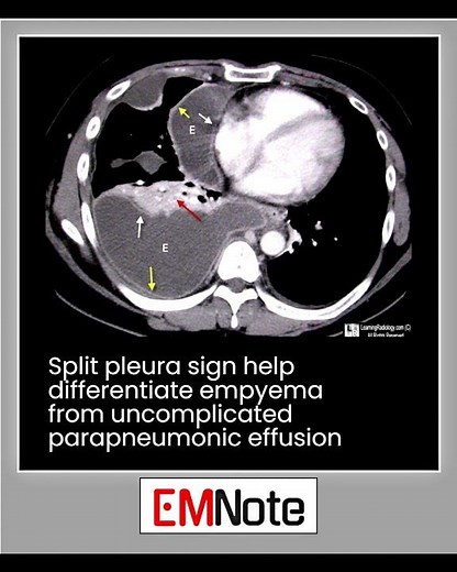 Split Pleura Sign #radiology #doctor #medical