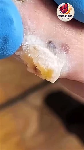 Essential Guide for People with Curved Nails to Prevent Calluses and Cracks 🌸🍎 #WellnessSeniors #FootSupport #SeniorHealth | Tots Mags Wheel