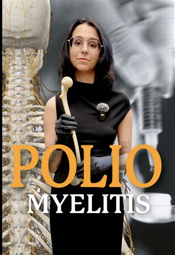 Polio’s Long-Term Impact on Femur Development