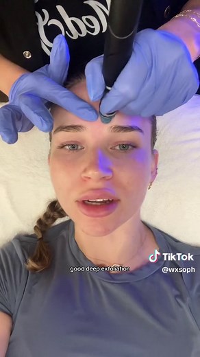 Hydrafacial Treatment for Acne: Step-by-Step Guide | Omega MedSpa