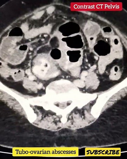 Tubo-ovarian abscesses - Radiology