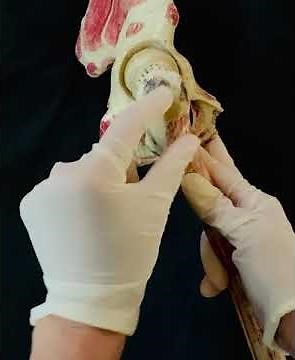 Paediatric hip anatomy for Sonographer’s - part 2