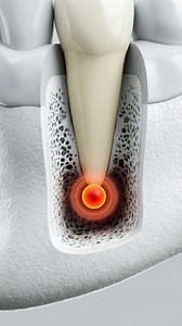 Does your old root canal hurt? Don't pull the tooth yet! 🛑 Watch how dentists fix a "failed" root canal using a procedure called Apicoectomy. We remove the infection at the tip, fill it with bone graft, and save your natural smile. 🦷✨ Like & Follow for more dental explanations! 👍 #dentistry #rootcanal #toothache #healthtips #dentalprocedures #saveyourteeth #medicalvideo #educational | 3D Teeth Care