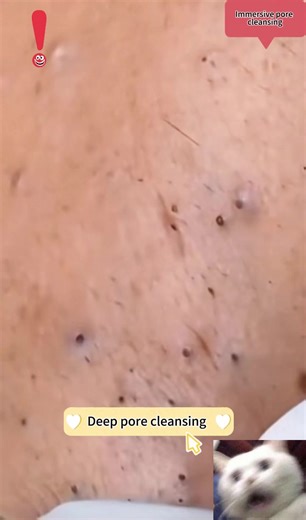 Acne Needle,clean your pores perfectly.Precise extractor for blackheads and spots.#BlackheadRemover #PoreCleaning #SkincareTools #AcneCare #FacialBeauty