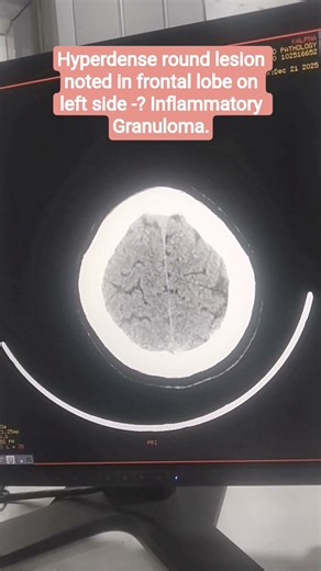 Hyperdense round lesion noted in frontal lobe on left side -? Inflammatory Granuloma. CT scan #MRI