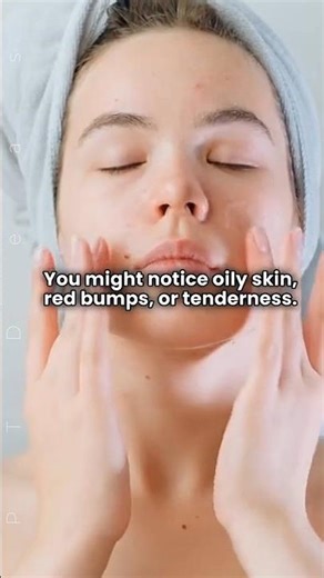 Acne Explained: Causes, Symptoms & Why It Happens at Any Age