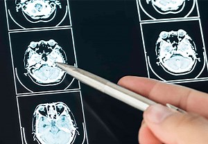 What is Vascular Neurosurgery? - Orlando Neurosurgery