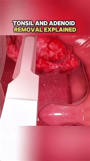 Tonsil adenoid removal (3DAnimation)