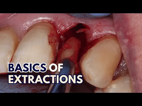Exodontia for Beginners - Extraction Techniques - PS012
