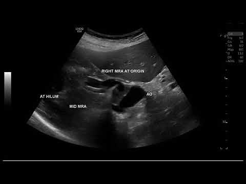 Abdominal Aortic Dissection doppler ultrasound