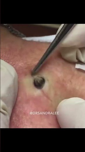 Dr Pimple Popper's Most Popular Pop #shorts