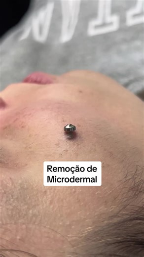 Remoção de Microdermal: Procedimento e Cuidados Após a Remoção
