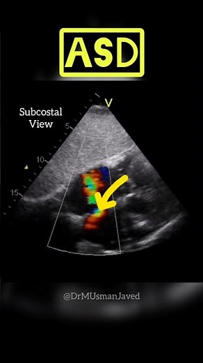 Atrial Septal Defect - ASD on Echocardiography #heart #heartdisease
