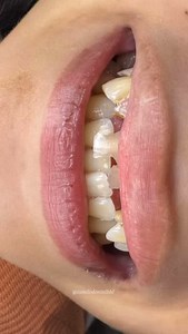2026 Smile transformation ✨ From hiding their smile to showing it proudly. This is why we do what we do. 🩶 Will be posting longer video of her smile transformation! Thank you to our patient for trusting us to bring back her confident smile! 😉 Open Mondays-Saturdays 9:00am-5:00pm, Sundays 9:30-4:00pm We accept walk ins too! 📍 I Smile Dental Care, Alex Avenue, CPG East Mansasa District, Tagbilaran City, Bohol 📞 (0995) 474 4005 ☎️ 422-8027 #ismiledentalbhl #dentist #bohol | I.Smile Dental Care 