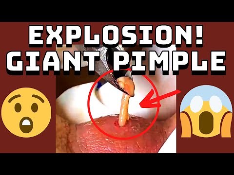 Giant Pimple Explosion Cyst Popping | Acne Pus Blackheads Bursting | ASMR Satisfying 33# 😱😱
