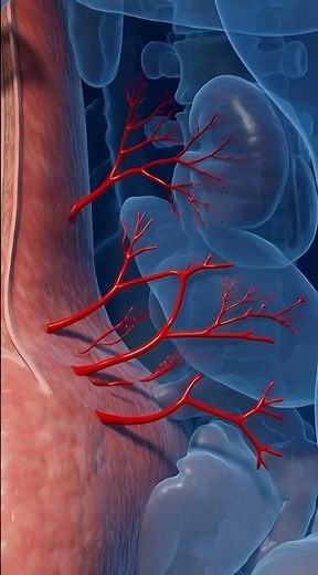Abdominal Aortic Aneurysm Repair in 3D | Open Surgery vs EVAR Explained