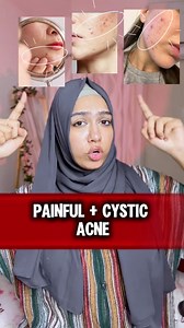 বড় বড় painful pimple দ্রুত দূর করবেন যেভাবে!! || Remove painful cystic acne fast || From Femauty page ✨ . . . . . #acne #cysticacne #beauty #skincare #skincaretips | The Charm Inside