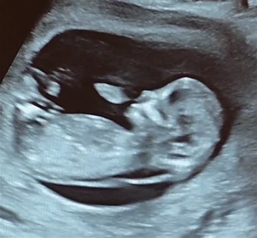 Fetal NT 3.5 mm with present nasal bone at 12 weeks: A case study | Coskun Umit posted on the topic | LinkedIn