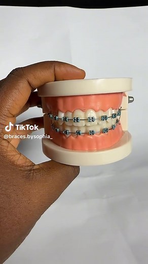 #CapCut #fypシ #bracesbysophia_ #braces #fashionbraces #jewelry #สปีดสโลว์ #สโลว์สมูท