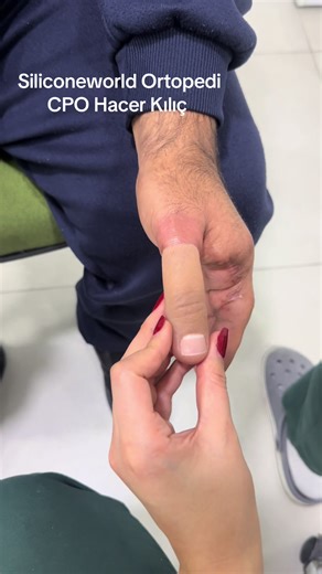 Silicone Finger Prosthesis: A Revolutionary Solution