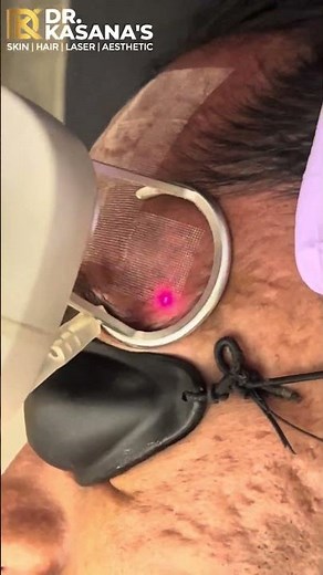 Acne Scars Treatment | acne scars remove with co2 laser #acnescars #acnetreatment