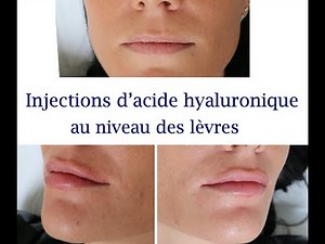 Injections des lèvres avec de l'acide hyaluronique ! Informations et explications