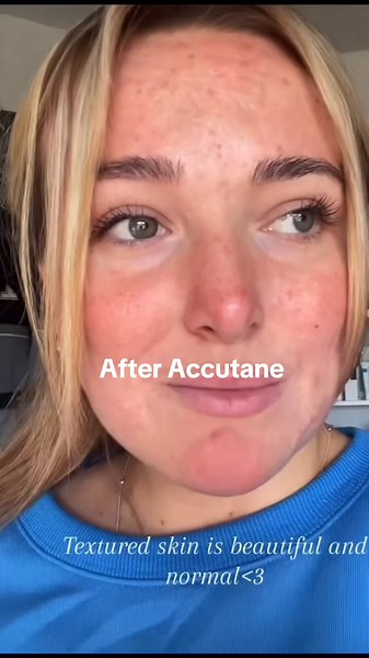 Real Acne Journey: Before vs After Accutane Transformation