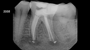 The limitations of traditional endodontic sealers (namely that they...