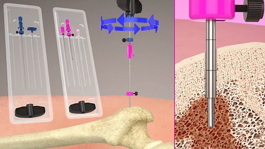 Huntington™ Bone Biopsy System Procedure
