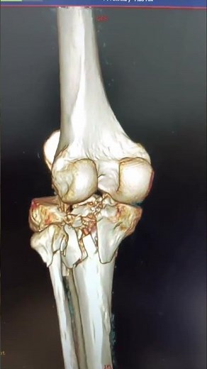 3D CT IN PROXIMAL TOBIA FRACTURES #otlife #medicaleducation #trauma