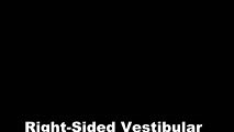 Vestibular Neuritis with   Head Impulse Test and Unidirectional Nystagmus | NOVEL - Daniel Gold Collection
