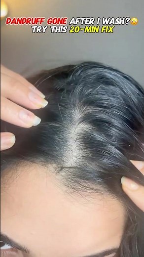 Dandruff Gone After 1 Wash?😳 20-Min DIY That Actually Works | anti dandruff diy hair mask #haircare