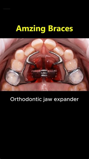 Amazing braces. Jaw expander and braces then #braces #orthodontist #dentist #teeth #orthodontics