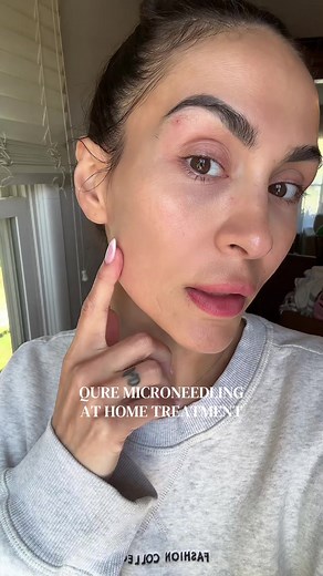 Honest Review of Qure Skincare Microneedling for Dark Spots